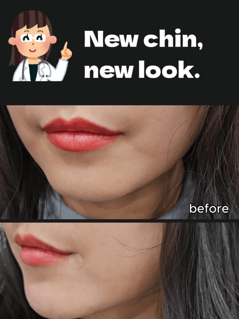 ✨ Chin Filler for Facial Balance ✨ A small change can make a big difference — especially in your side profile. At Gangnam HERA Clinic in Seoul, chin filler is designed to: ✔ Improve facial harmony ✔ Enhance the jawline naturally ✔ Create a softer V-line effect ✔ Support a more defined profile (without surgery) Our treatments are doctor-performed, highly precise, and always tailored to your unique facial structure. If you’re looking for natural chin filler in Gangnam, Seoul, we offer full English support for international patients. 📍Gangnam, Seoul 📩 DM us for consultation & booking