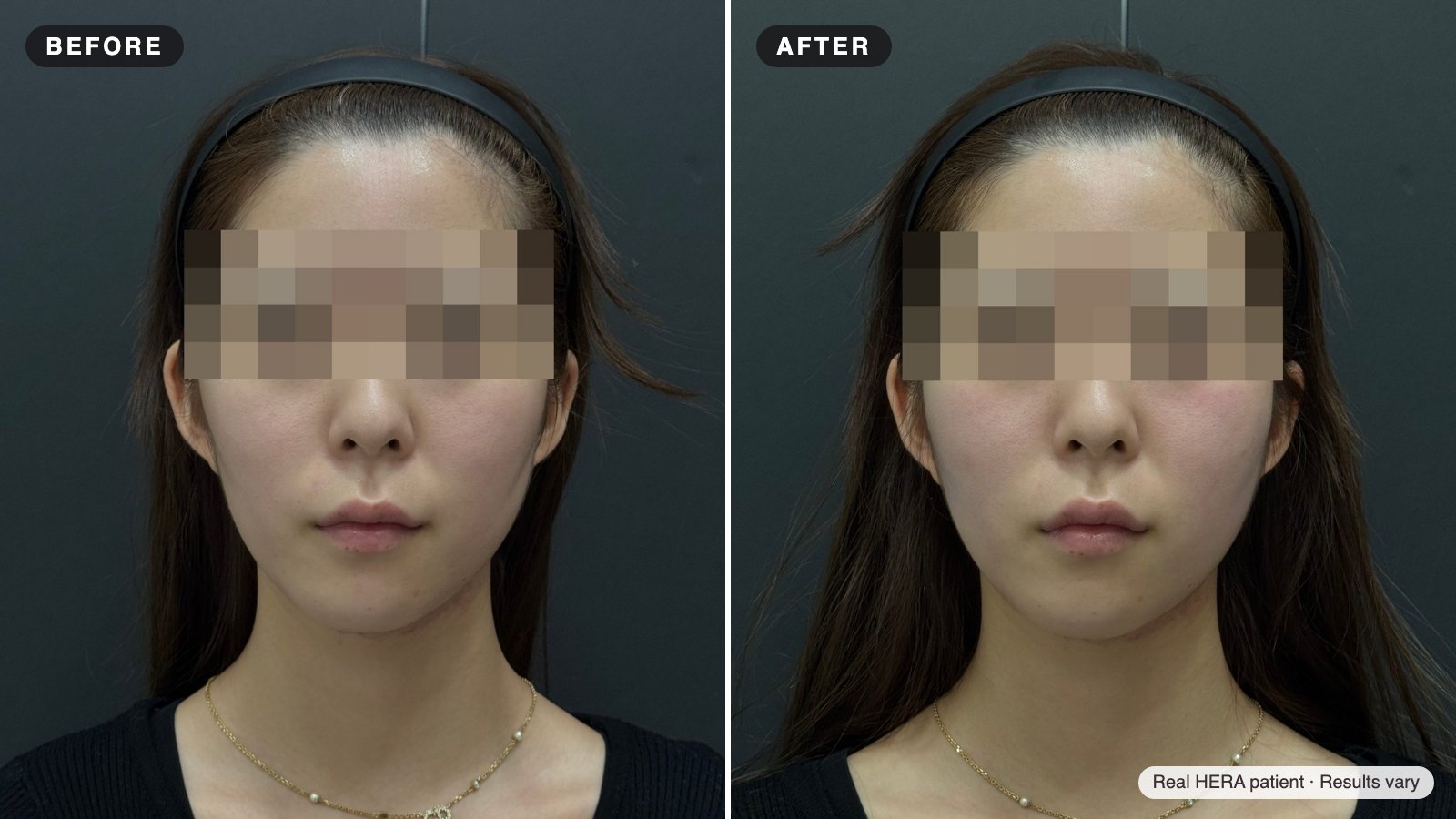 헤라 실제 환자 전후 사진