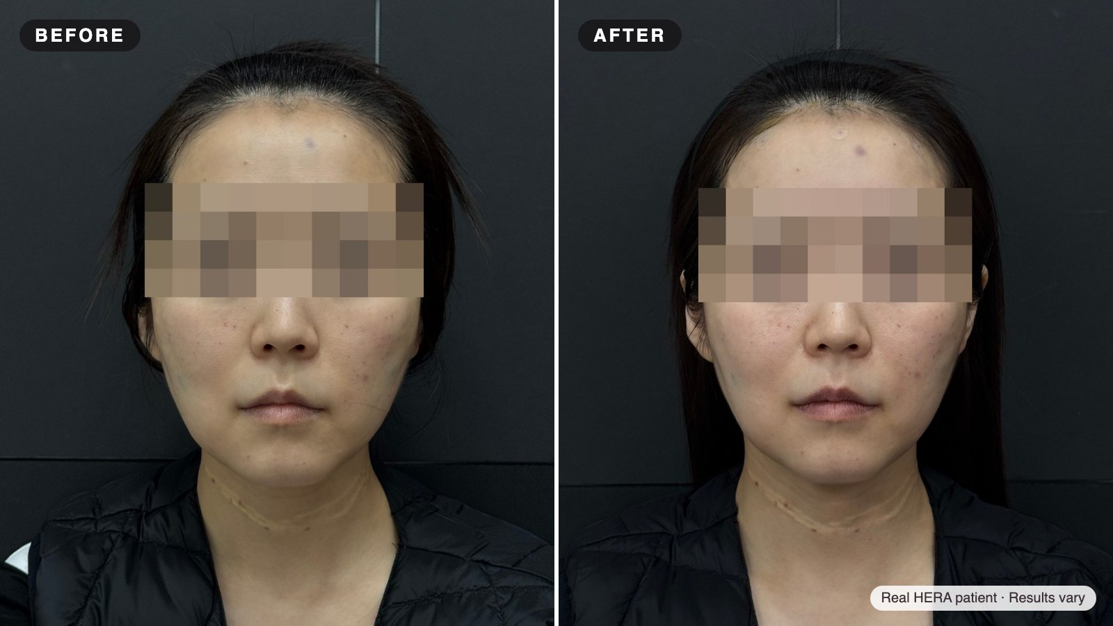 헤라 실제 환자 전후 사진