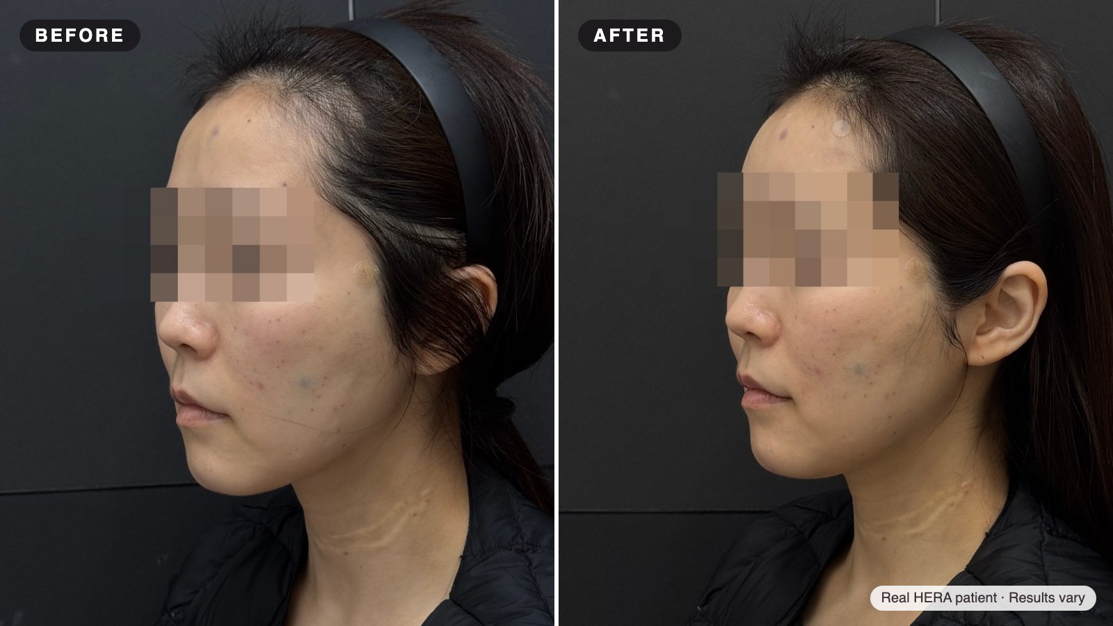 Real HERA patient before and after