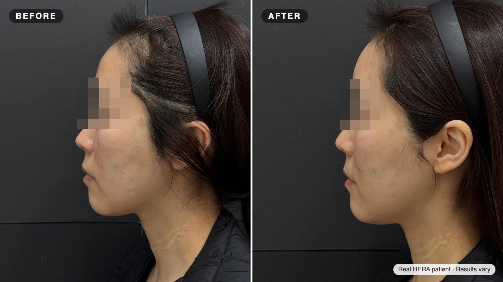 Real HERA patient before and after