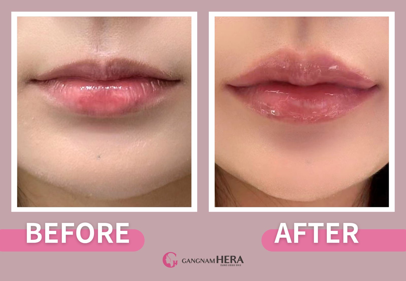 Close-up of lip filler results in Korea showing a defined vermilion border and smooth, hydrated lip texture