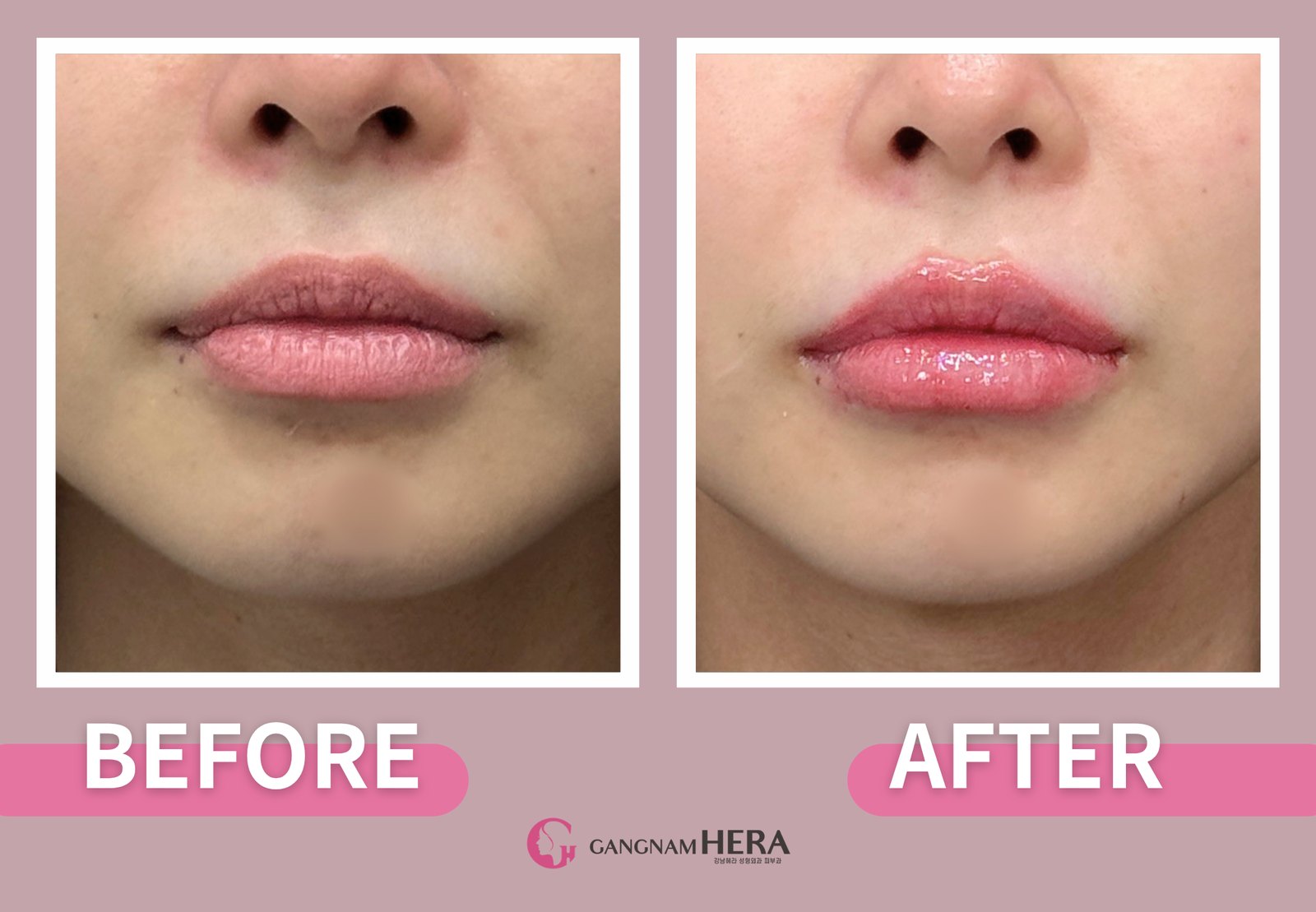 Korea lip filler before and after — front view showing added centre volume and a defined lip border at HERA Clinic Gangnam