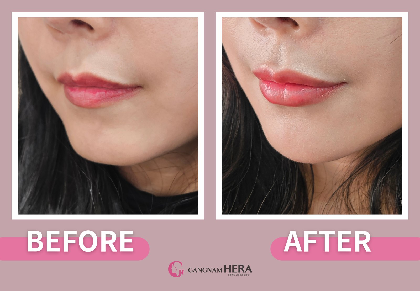 Lip filler Korea before and after at a 45-degree angle showing natural profile projection without over-filling