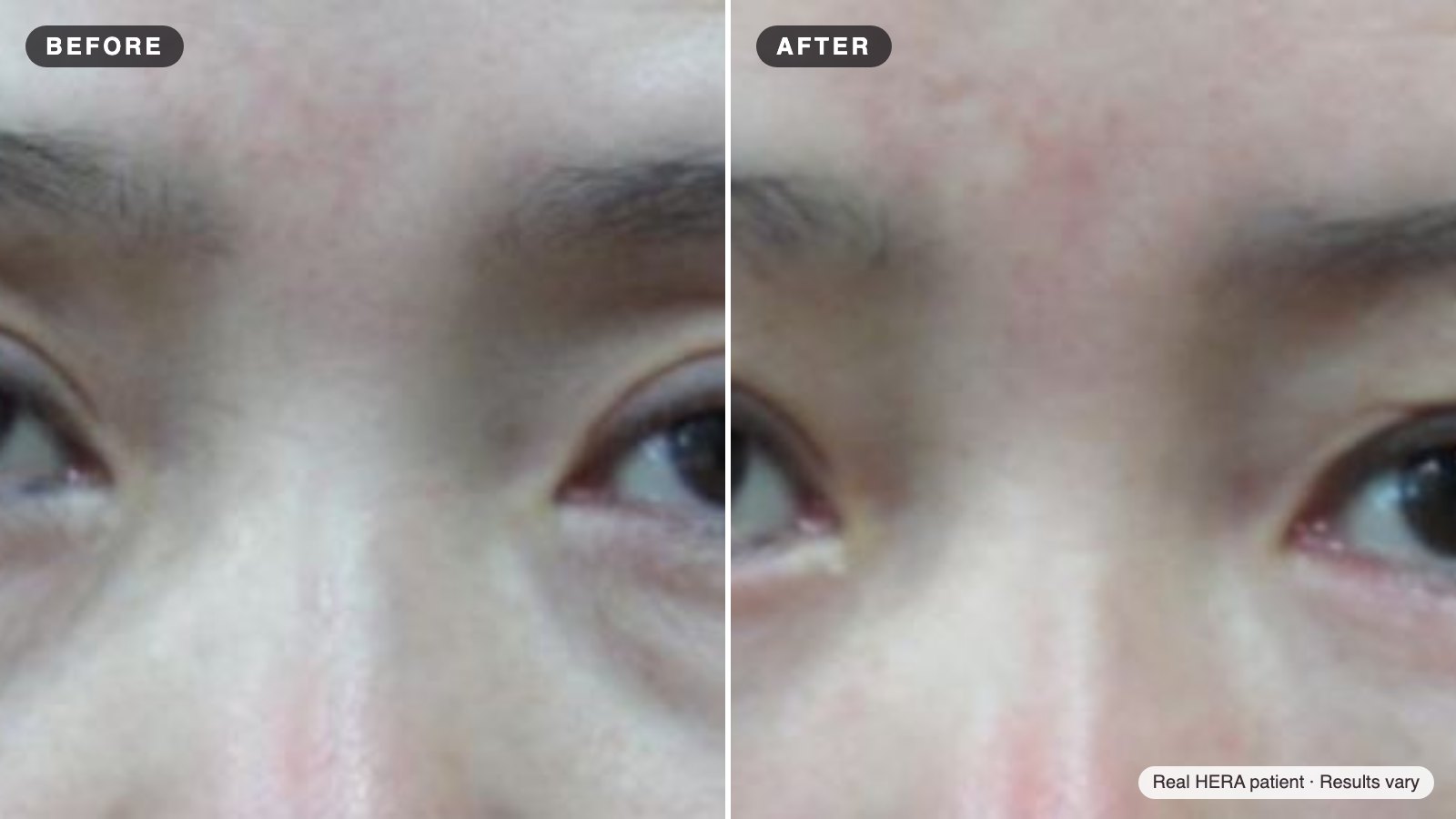 Real HERA patient before and after