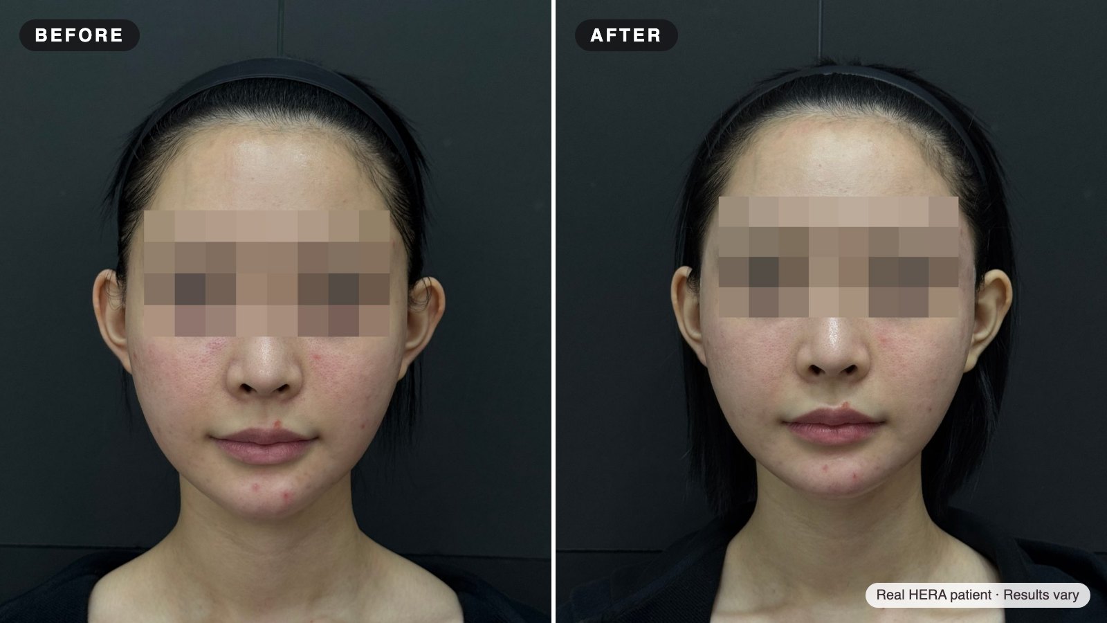 헤라 실제 환자 전후 사진